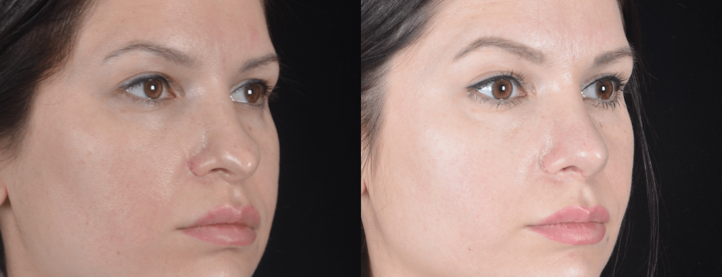 Вторичная ринопластика кончика носа  фото до и после