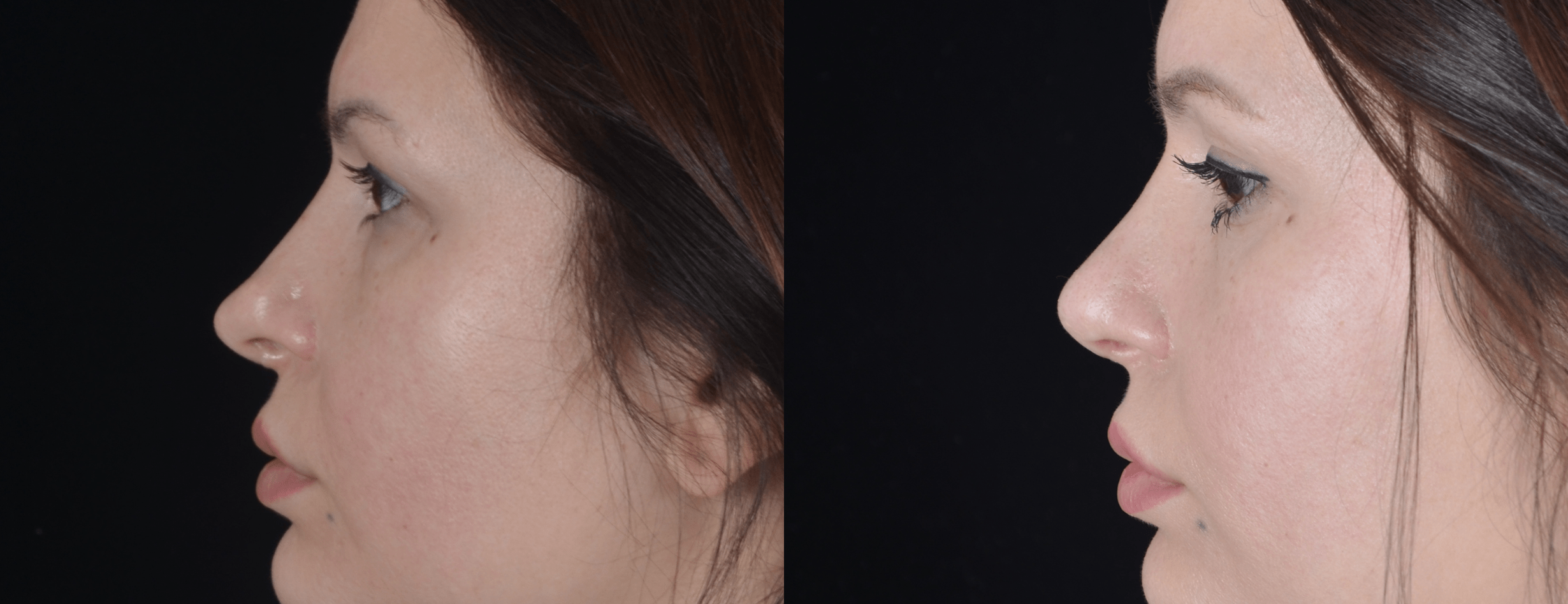 Вторичная ринопластика кончика носа  фото до и после