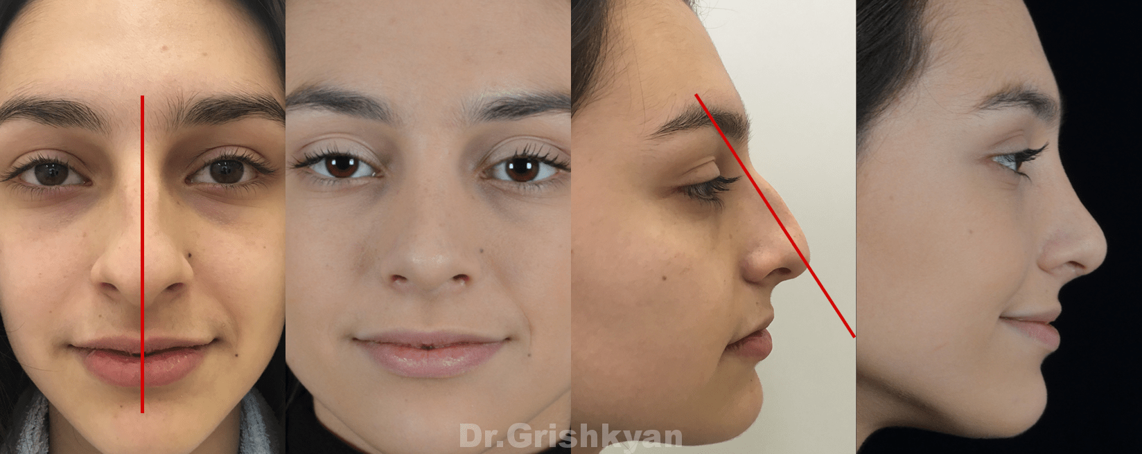 На фотографии можно видеть пациентку до и после пластики спинки носа (удаление горбинки и исправление кривизны спинки носа)