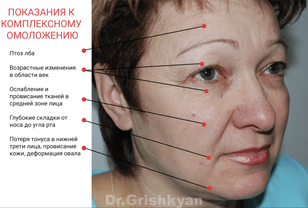 Хирургическая подтяжка лица, пластика лица в Москве