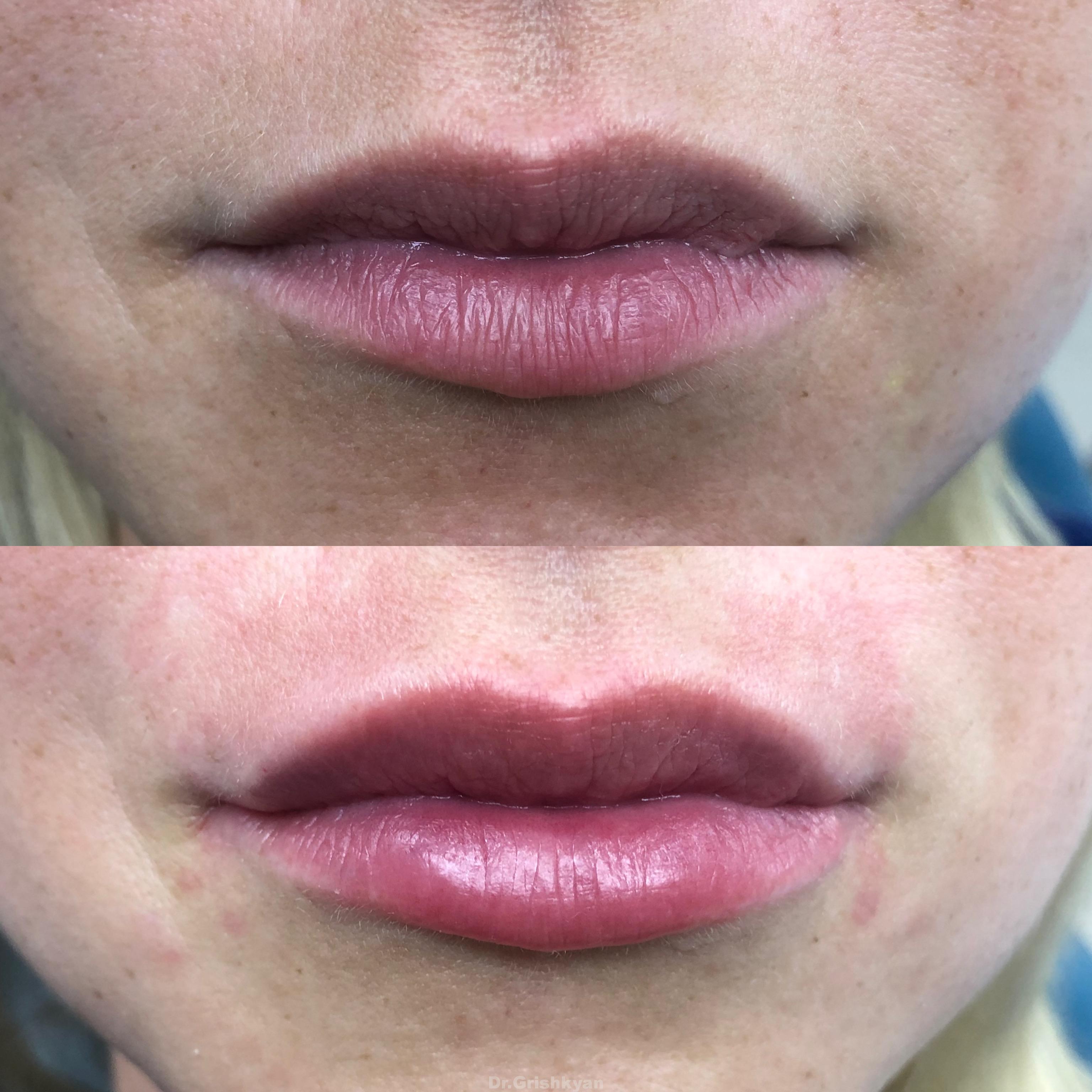 косметология губы