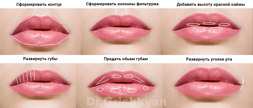 Увеличение губ на основе гиалуроновой кислоты