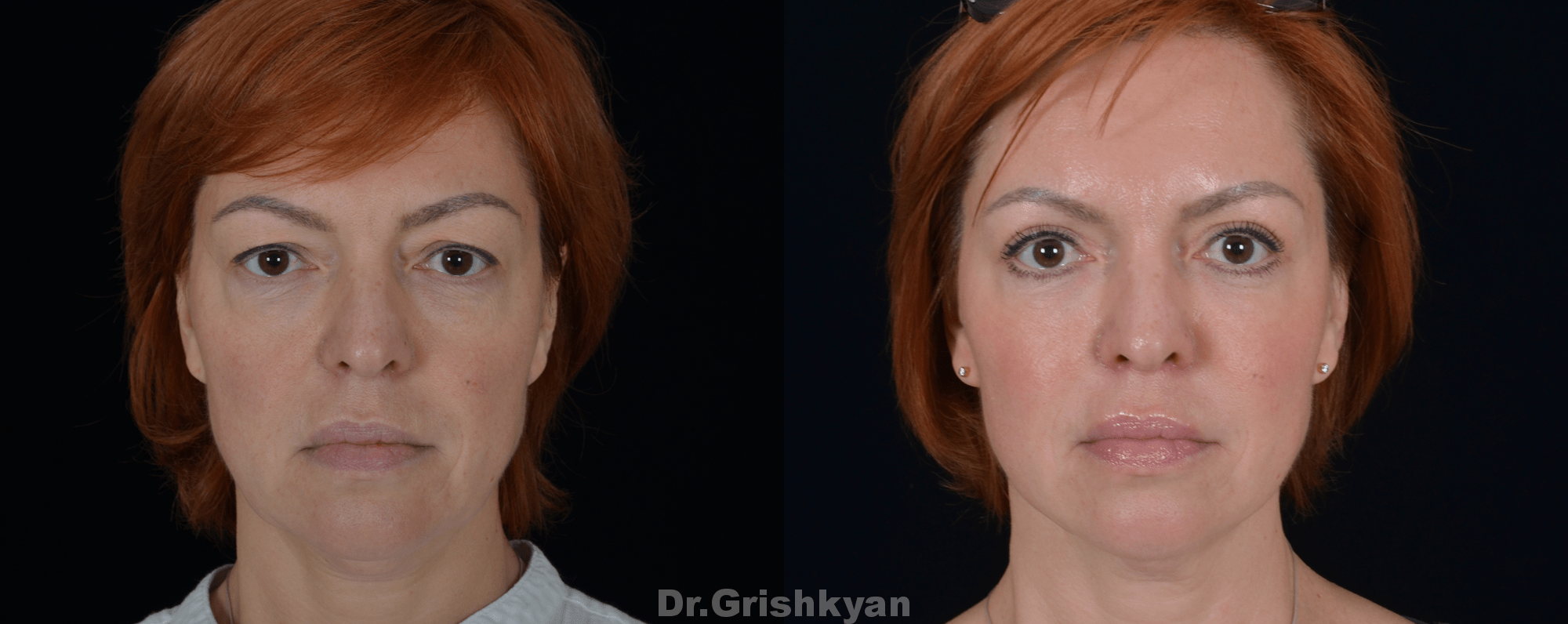 Липофилинг лица и пластика верхних век, фото до и после