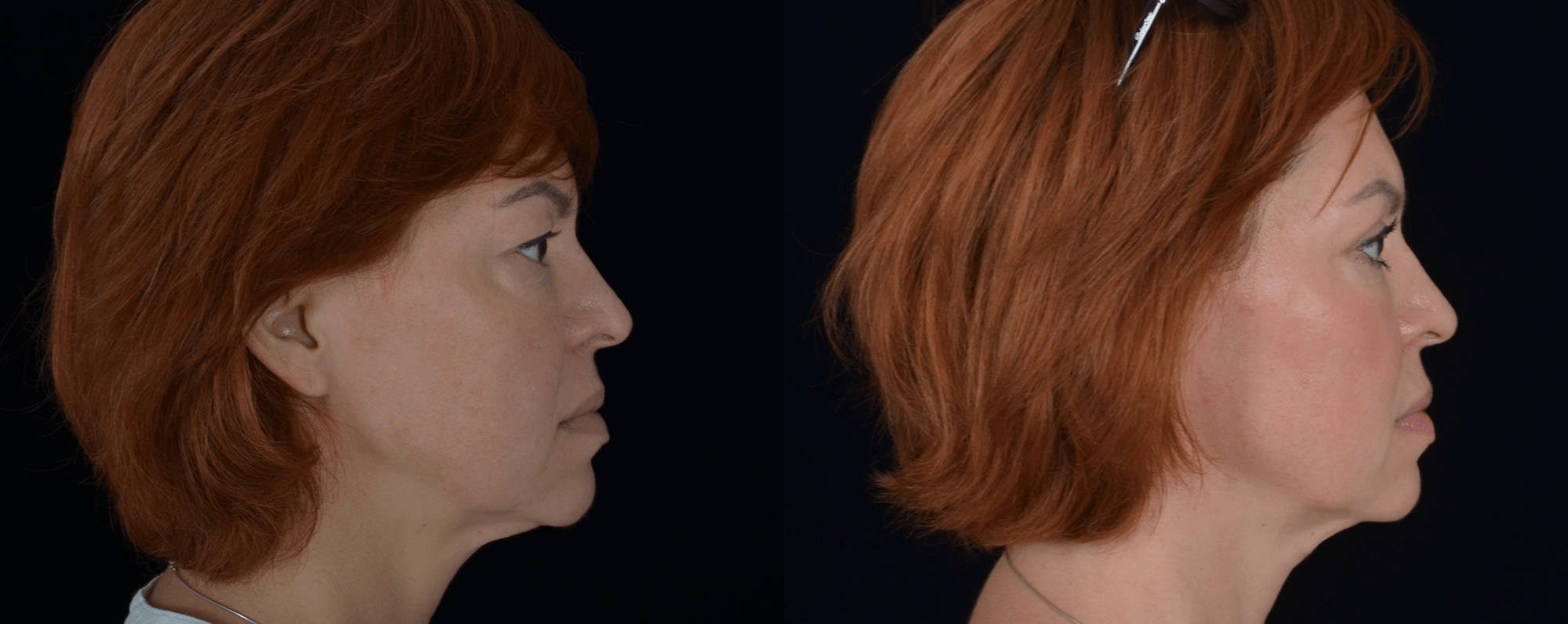 Липофилинг лица и пластика верхних век, фото до и после