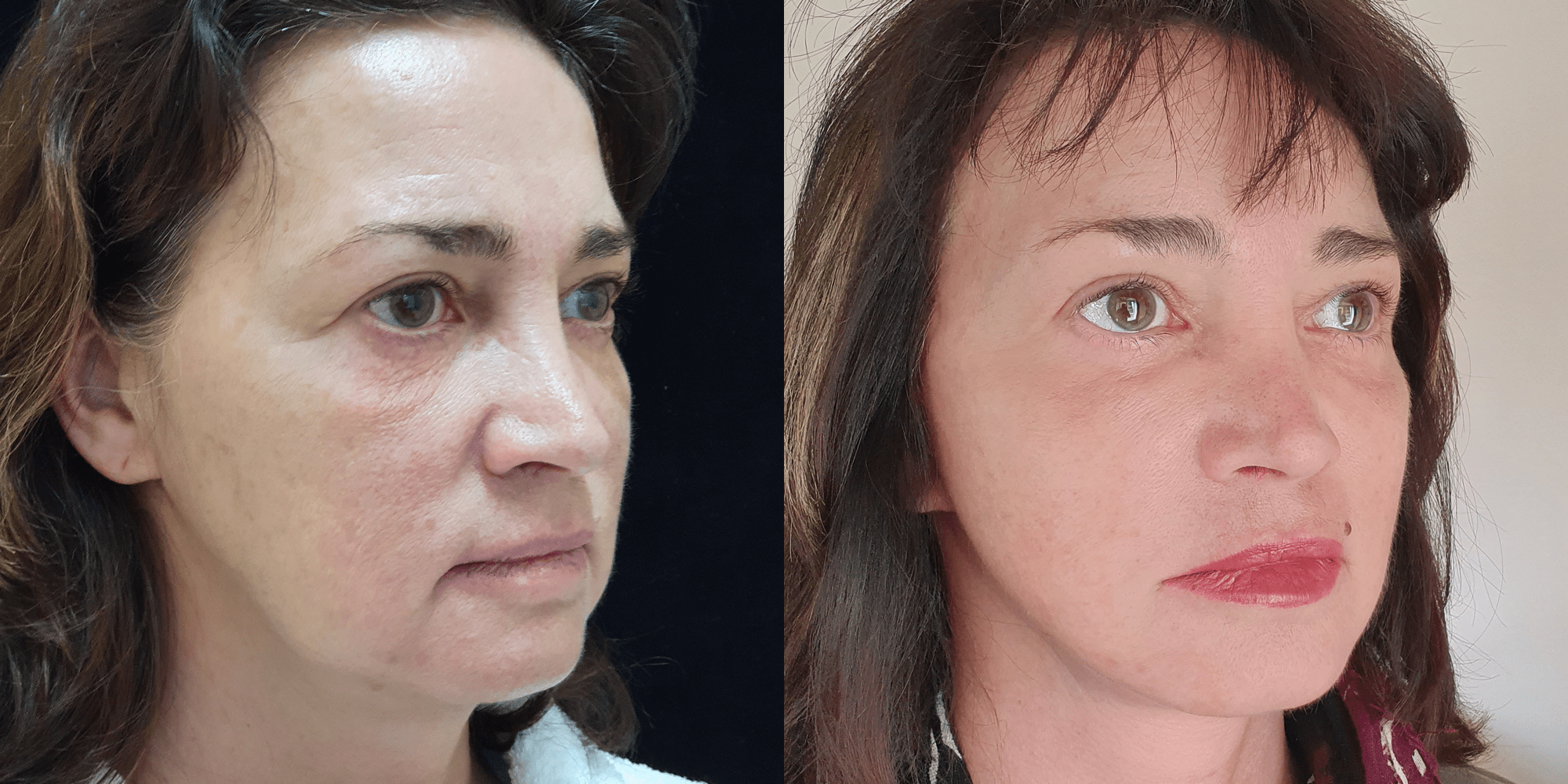 Фото пластика лица До и После