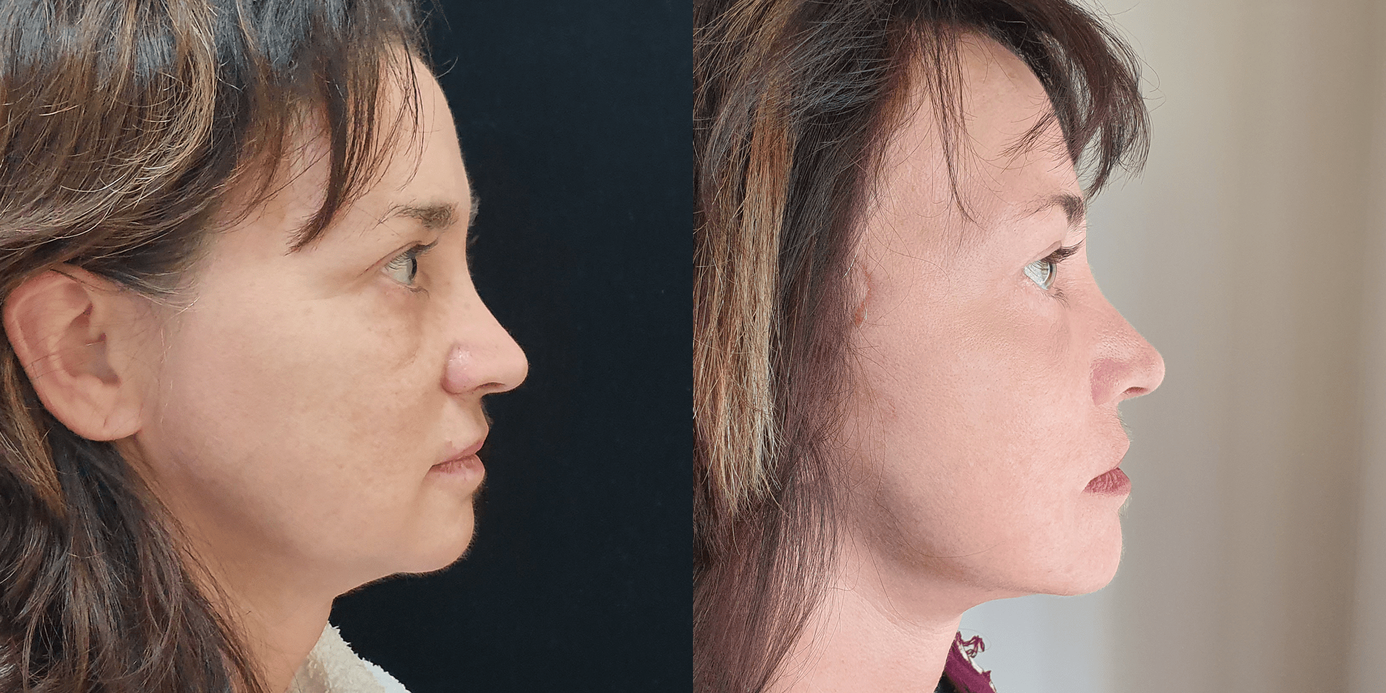 Фото пластика лица До и После