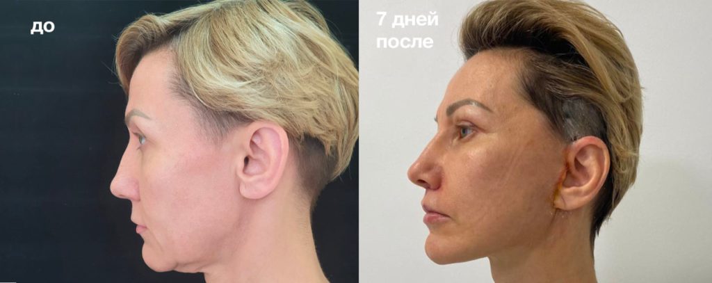 Подтяжка лица до и после