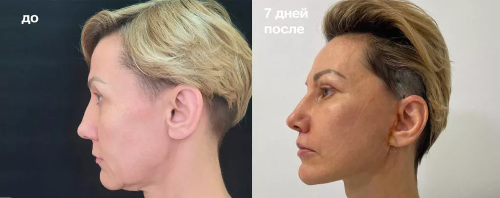 Подтяжка лица до и после