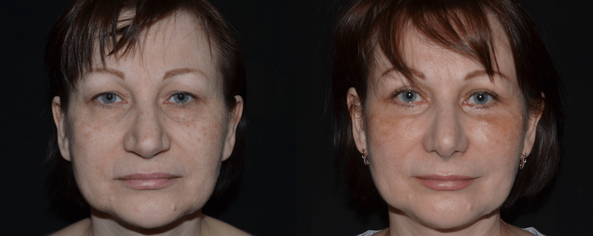 ринопластика носа до и после фото