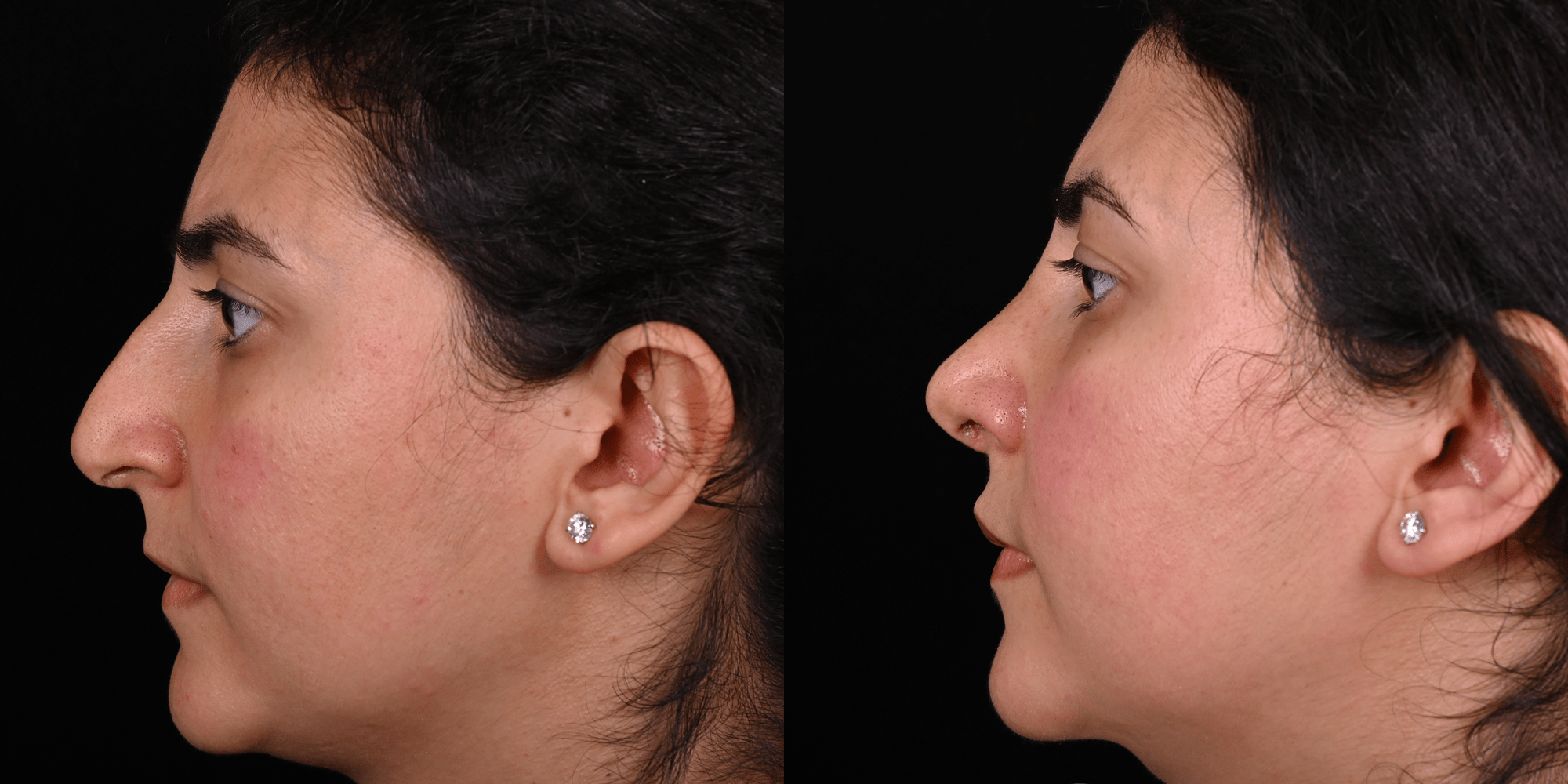 Ринопластика с устранением асимметрии кончика и устранением горбинки носа