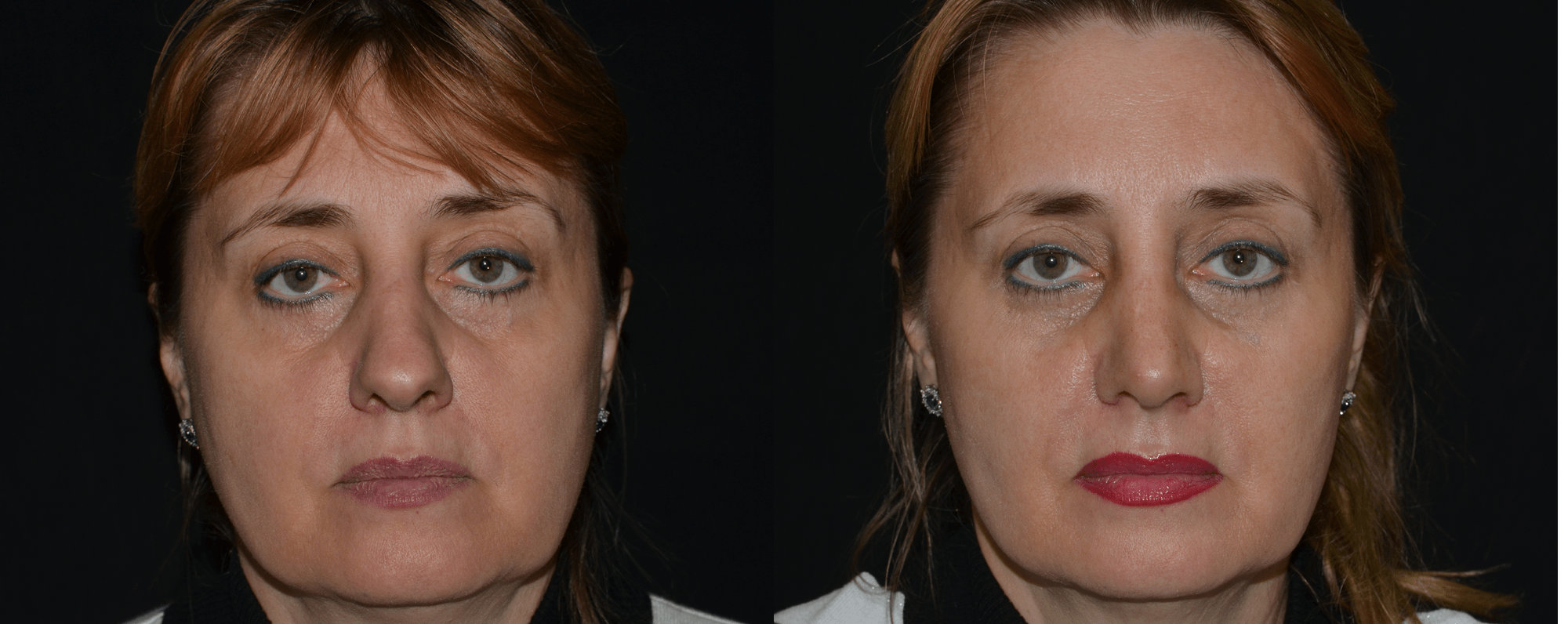 Омолаживающая ринопластика фото До и После