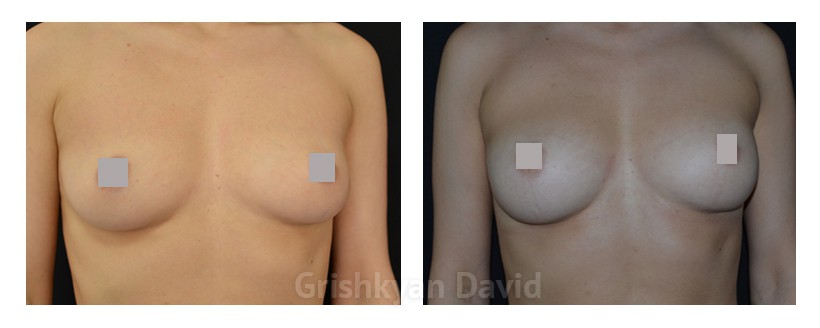 липофилинг груди фото до и после