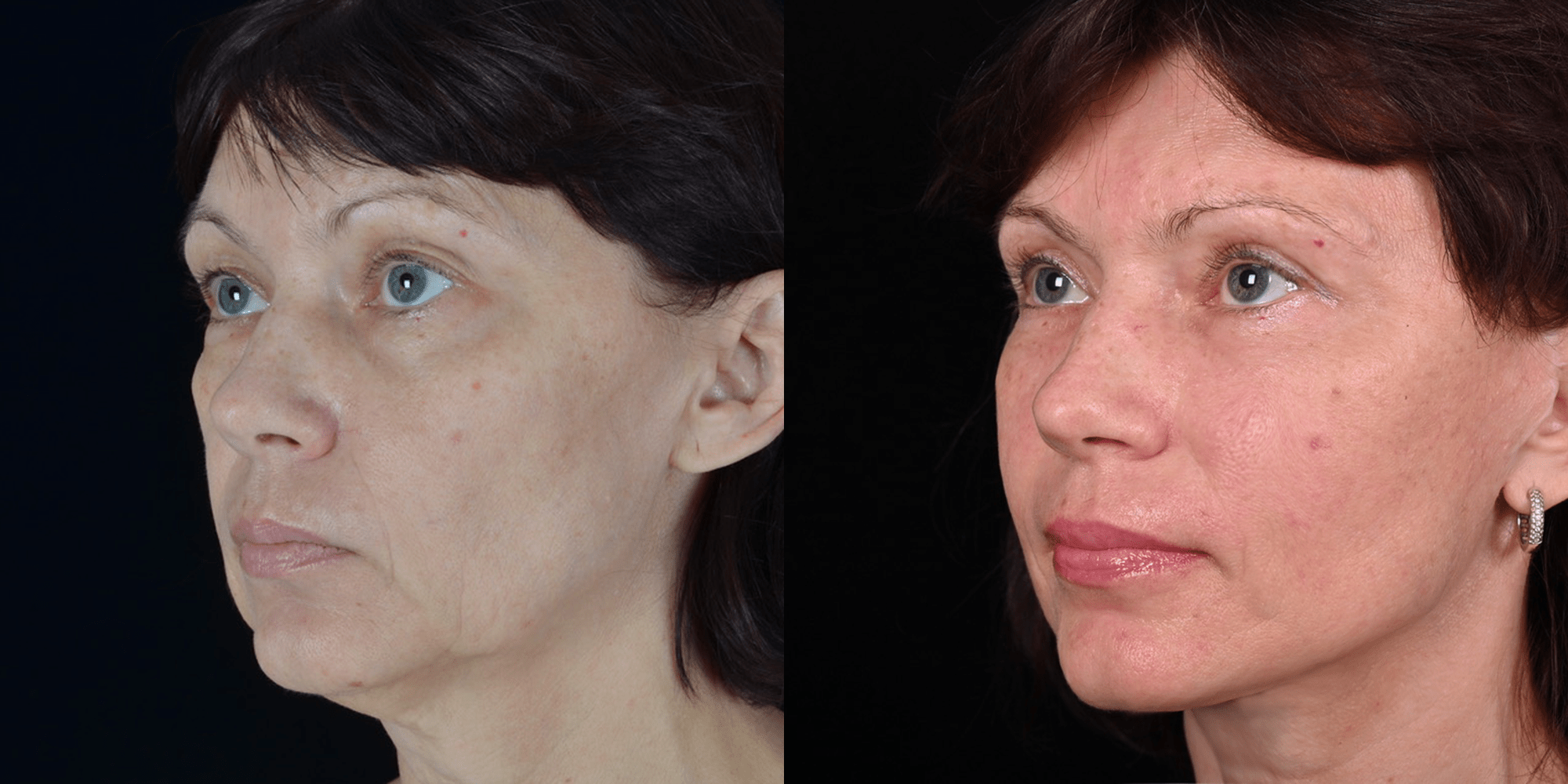 результаты до и после пластики лица в клинике Гришкяна