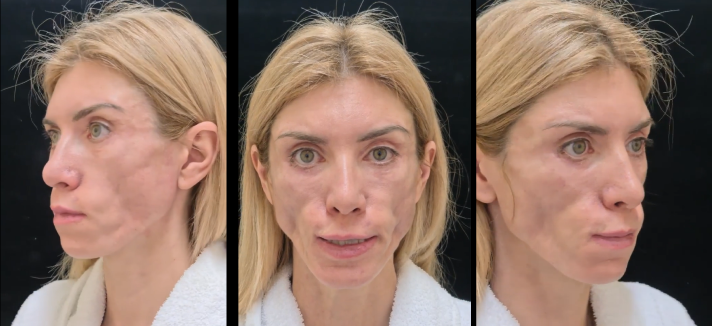 Липофилинг лица. Липофилинг лица до и после. Неудачные пластические операции. Операция в 75 лет