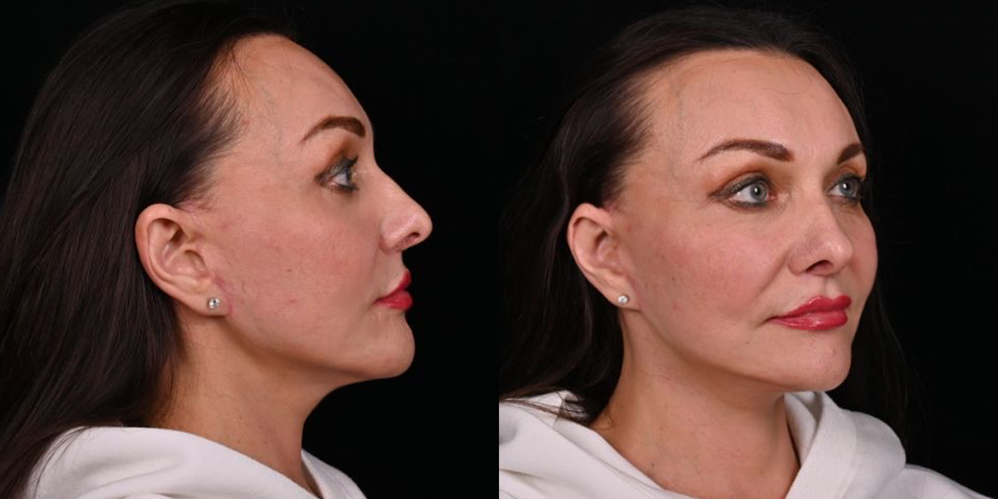 фото пластики лица до и после