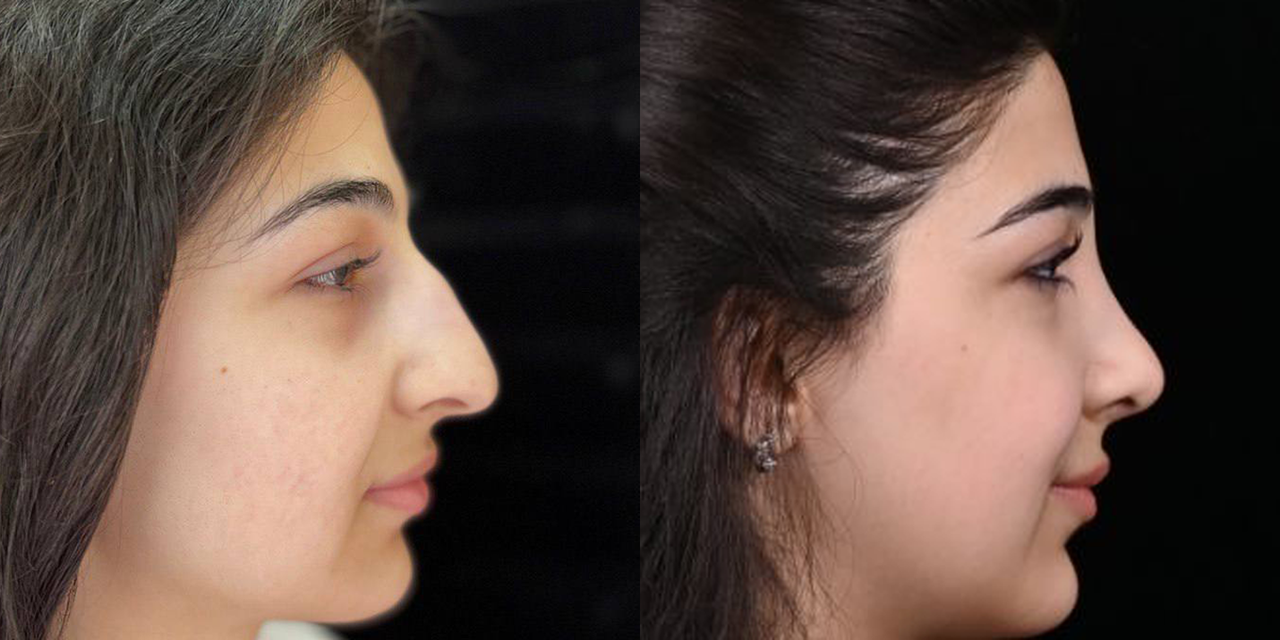 Ринопластика носа у молодой девушки