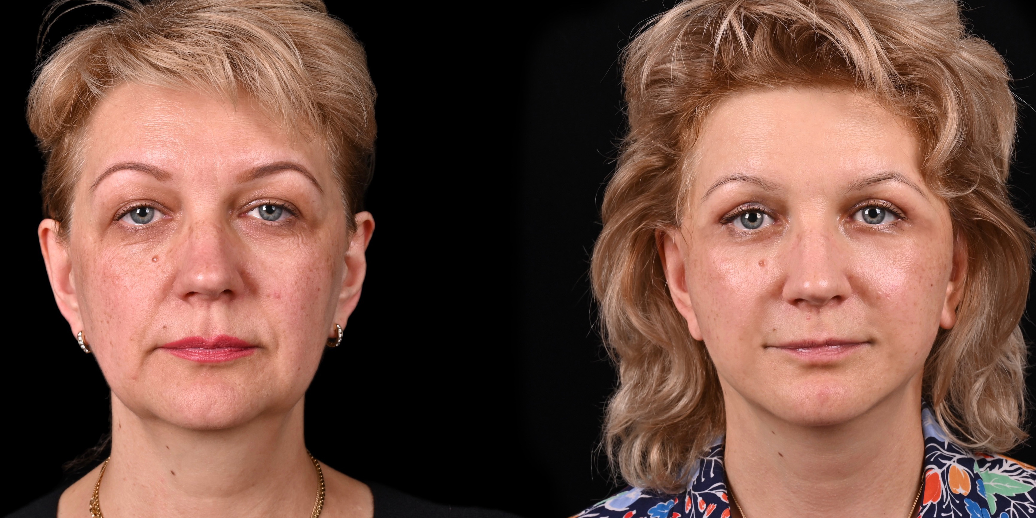 Пластика лица и шеи в фото до и после в клинике в Москве
