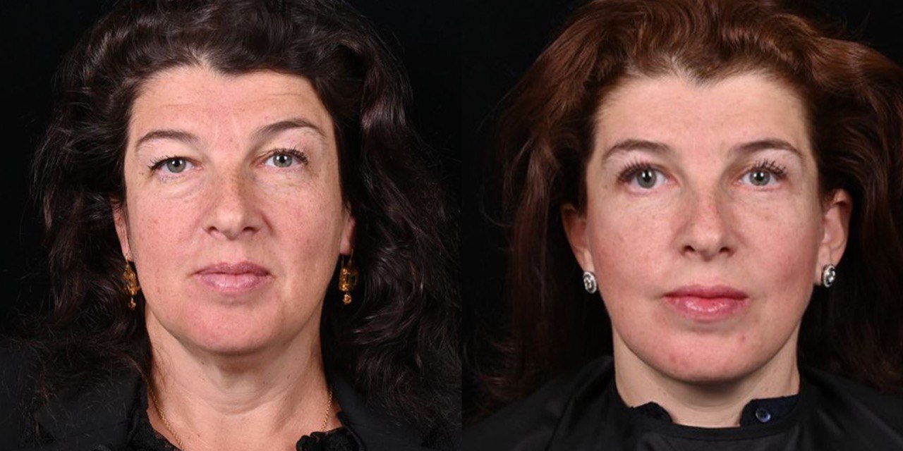пластика лица в фото до и после