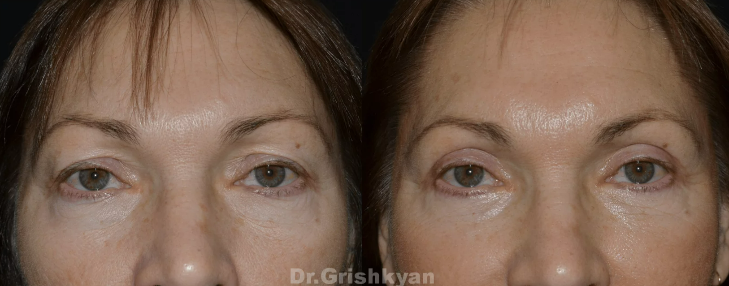 Восстановление после блефаропластики: можно ли ускорить процесс и какие процедуры существуют