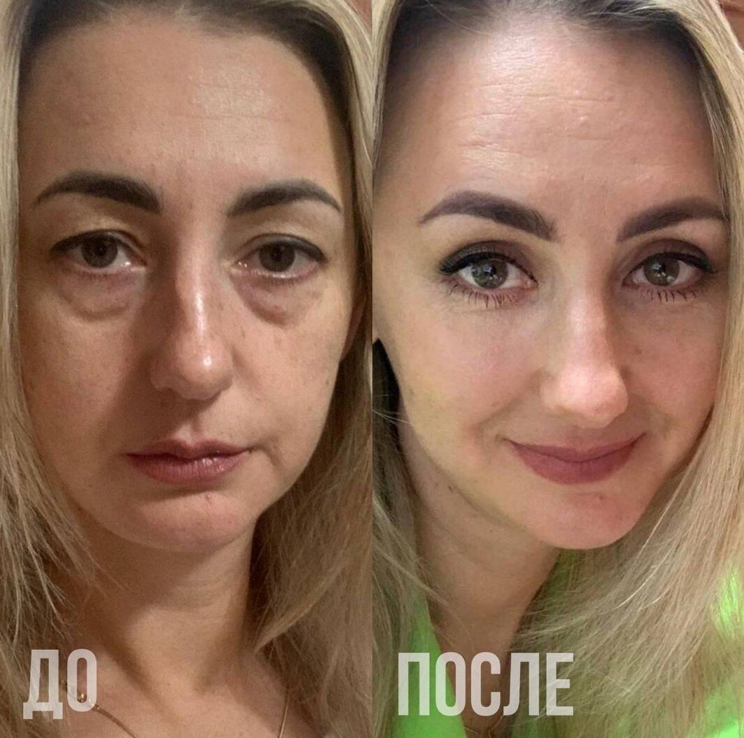 Как можно убрать жировые грыжи на веках