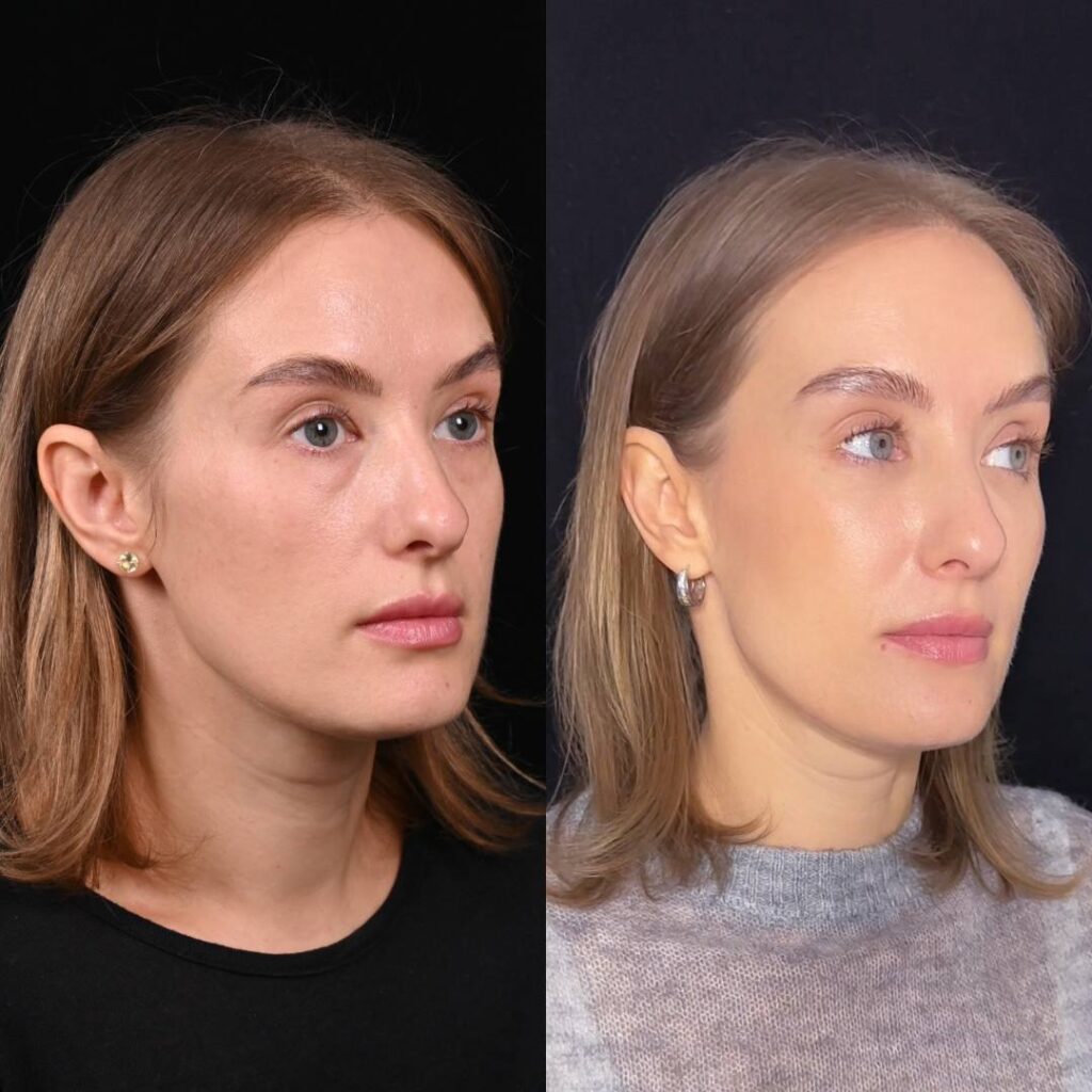 Липофилинг средней зоны лица